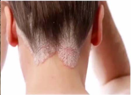 Foto Psoriasis
