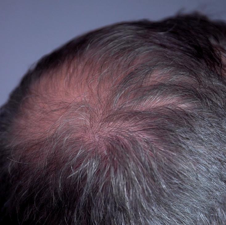 Haar ongevuld zonder haarvezels